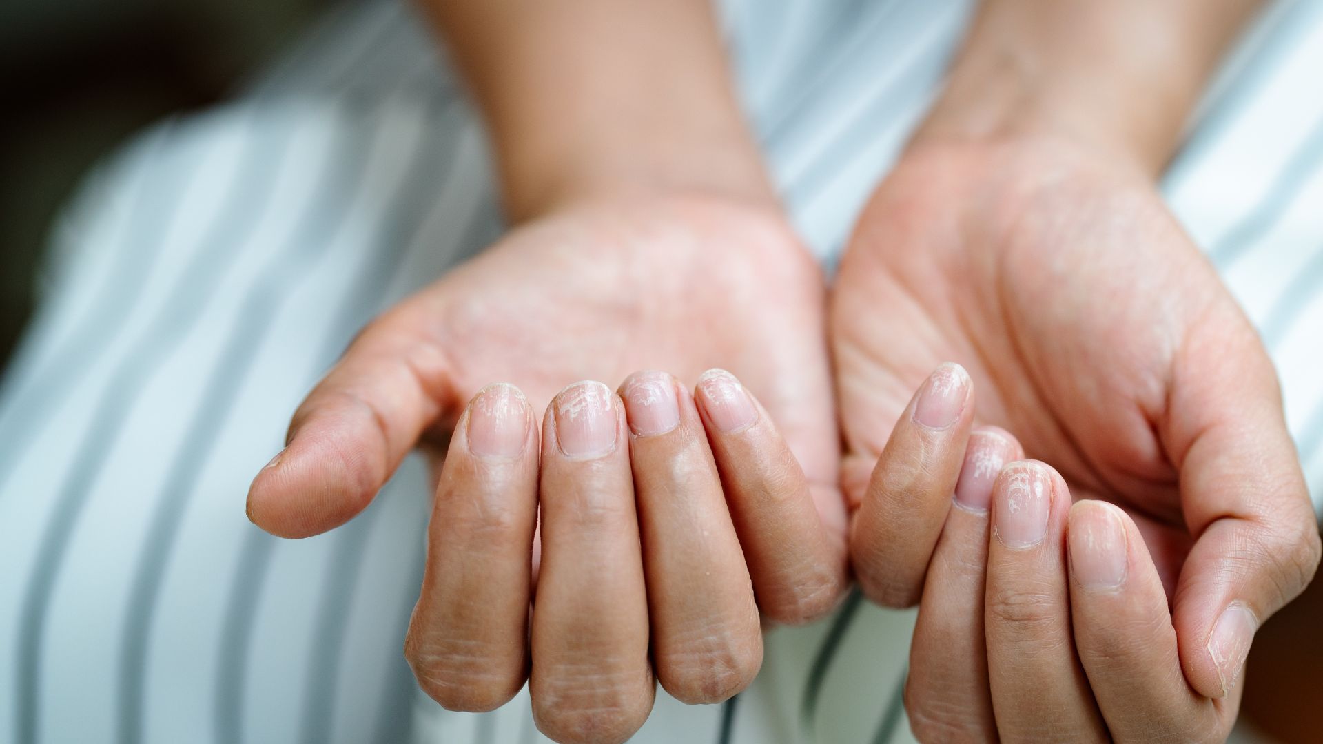 Trápi vás zvýšená lámavosť nechtov Takto ju vyriešite raz a navždya